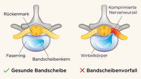 Bandscheibenvorfall