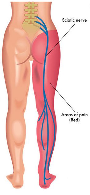 Ischias Nerv und Lokalisation der Schmerzen